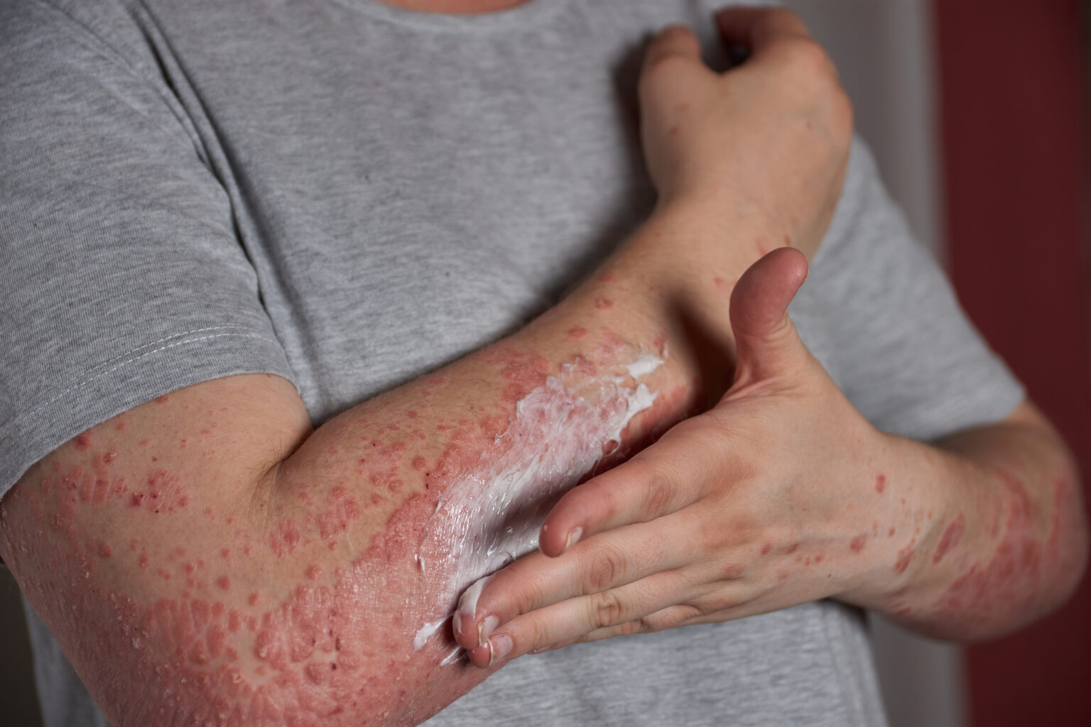 TSW sindrom: Kada koža traži detoks od steroida