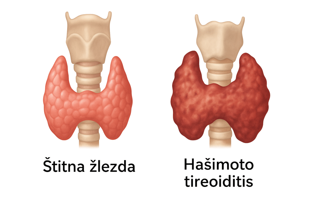 na slici je prikazana anatomija stitne zlezde normalnoe strukture, a na desnoj strani je stitna zljezda koja je imenjenog oblika i teksture zbog upale tj dejstva antitela.